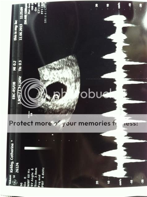 accuracy of dating scan at 10 weeks